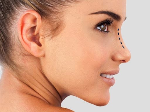Rinoplastia